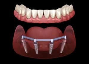 Dental implant prosthetic showing tooth crown above implant fixture with four anchoring screws in jawbone model.
