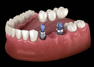 Dental implants placed in jawbone model showing titanium posts for tooth replacement.