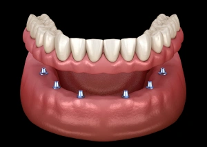 Dental implant prosthesis showing artificial teeth anchored to jawbone with implant posts.