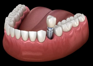 Dental implant model showing artificial tooth fixture integrated into gum tissue structure.