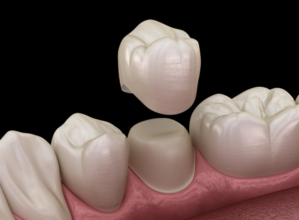 Dental crowns displayed on model gums showing tooth restoration options in various sizes.