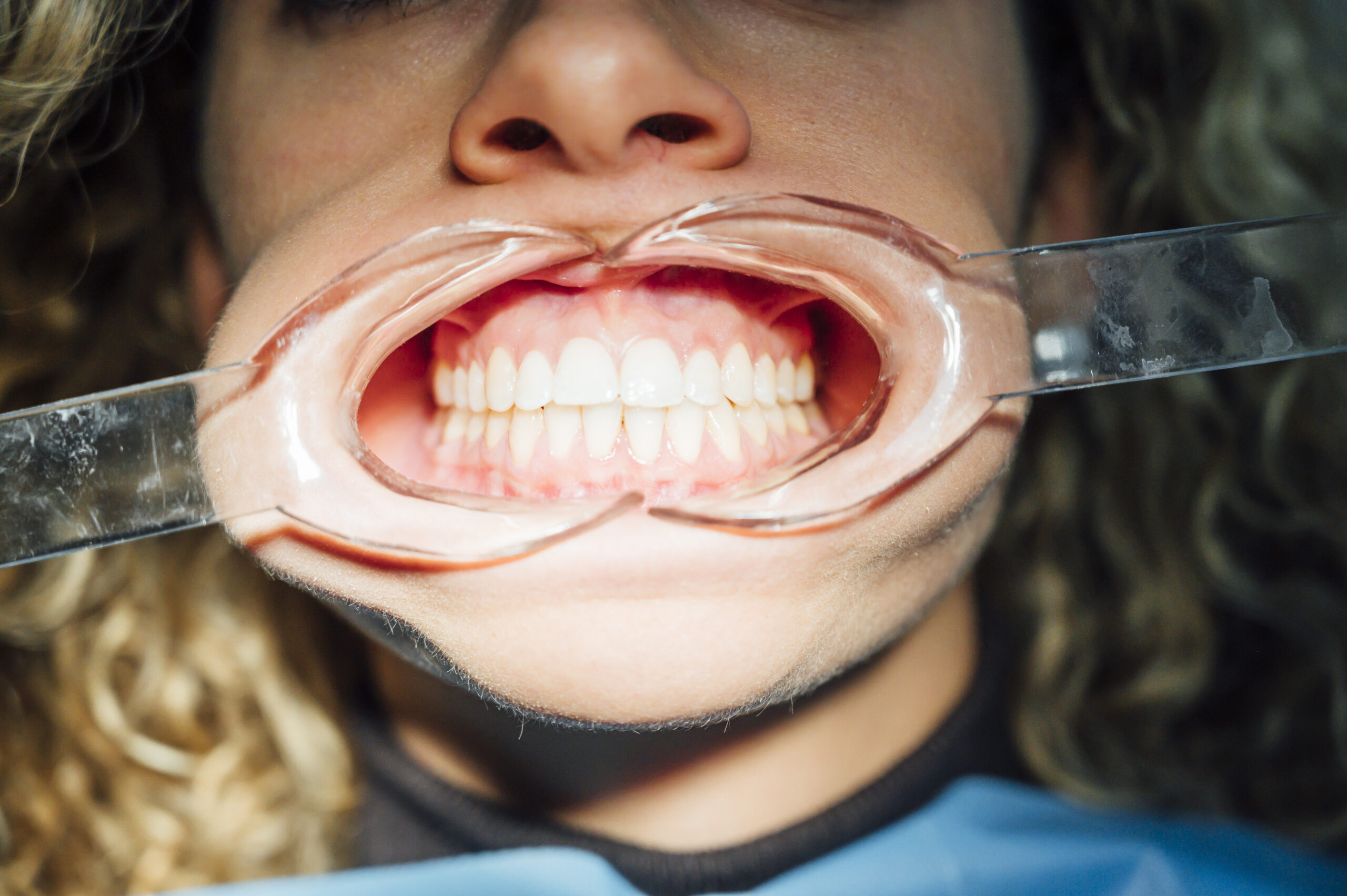 Child demonstrating wide smile with cheek retractors showing healthy white teeth and gums.