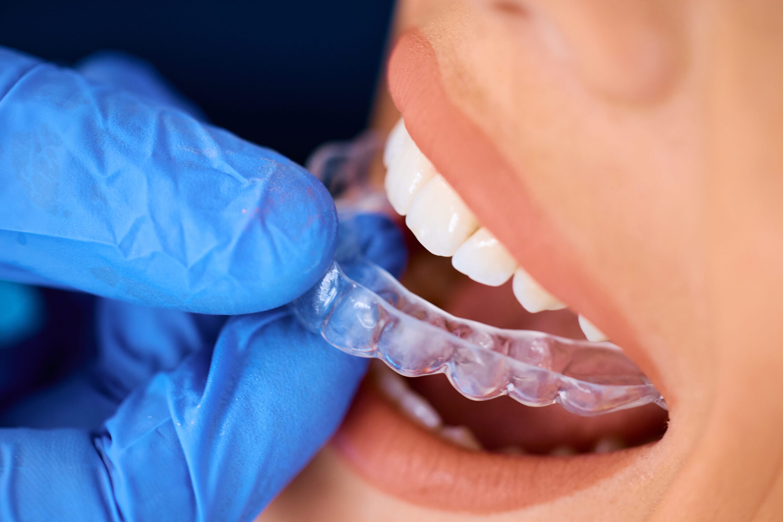 What Happens If You Don't Wear Your Aligners Enough - patient holding clear aligners